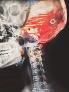 Hurt in Houston | Catastrophic Injury Lawyer